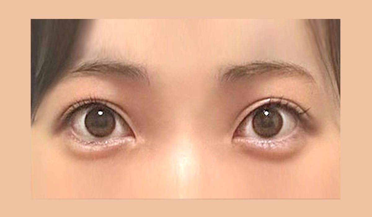 눈꼬리의 방향을 고려한 사례 수술 후