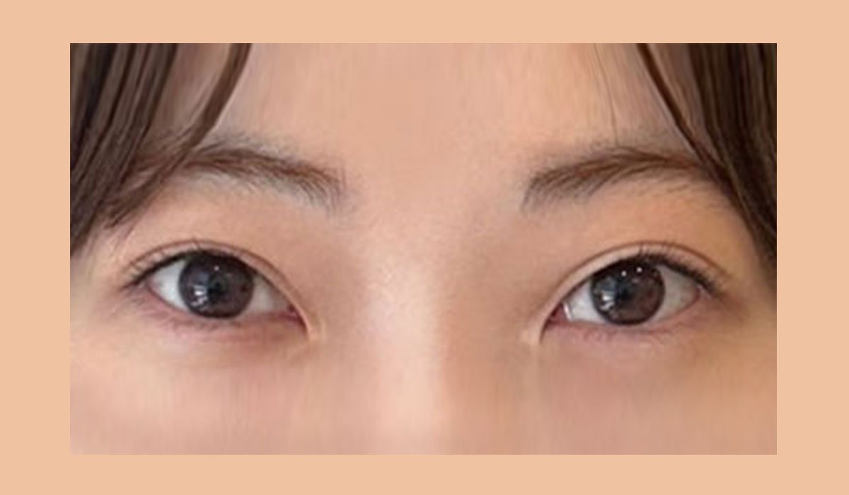 눈꼬리의 방향을 고려한 사례 수술 전