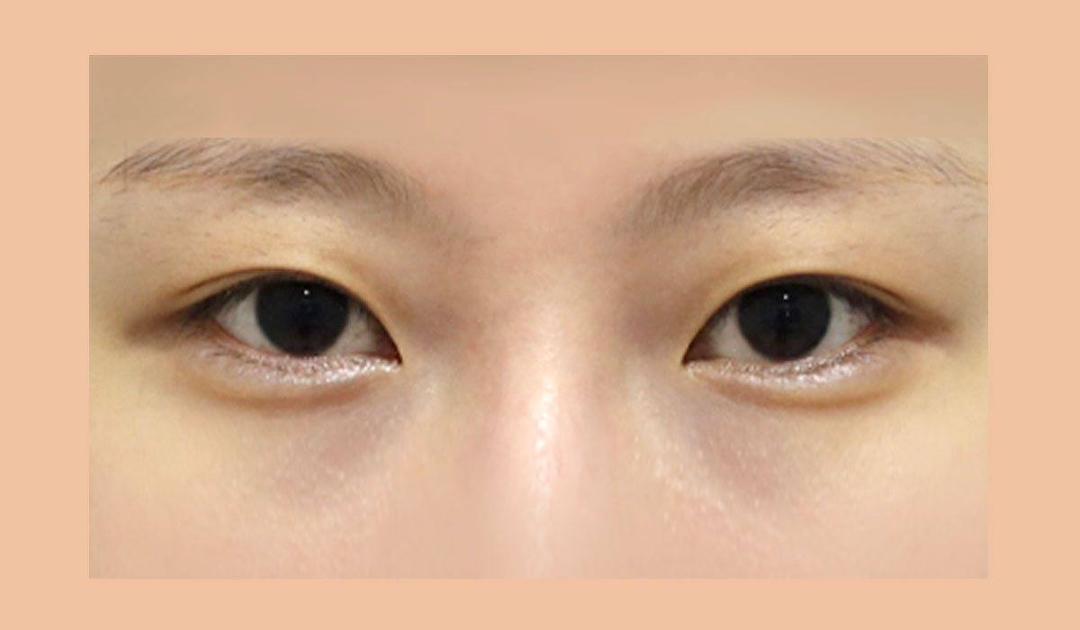 눈의 가로 길이와 눈꼬리의 균형을 고려한 사례 수술 전