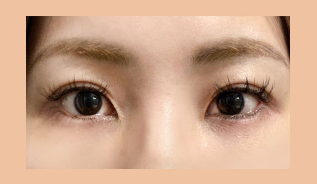 개인별 눈 구조에 맞춰 디자인한 사례 수술 후