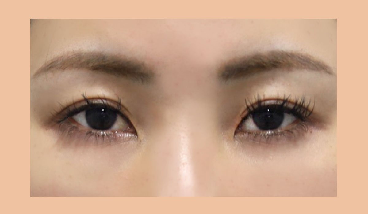개인별 눈 구조에 맞춰 디자인한 사례 수술 전
