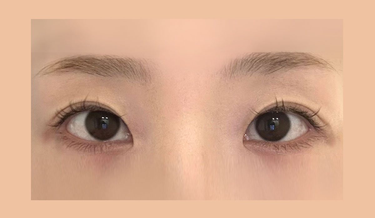 절개 뒤밑트임 전후 사례 수술 후