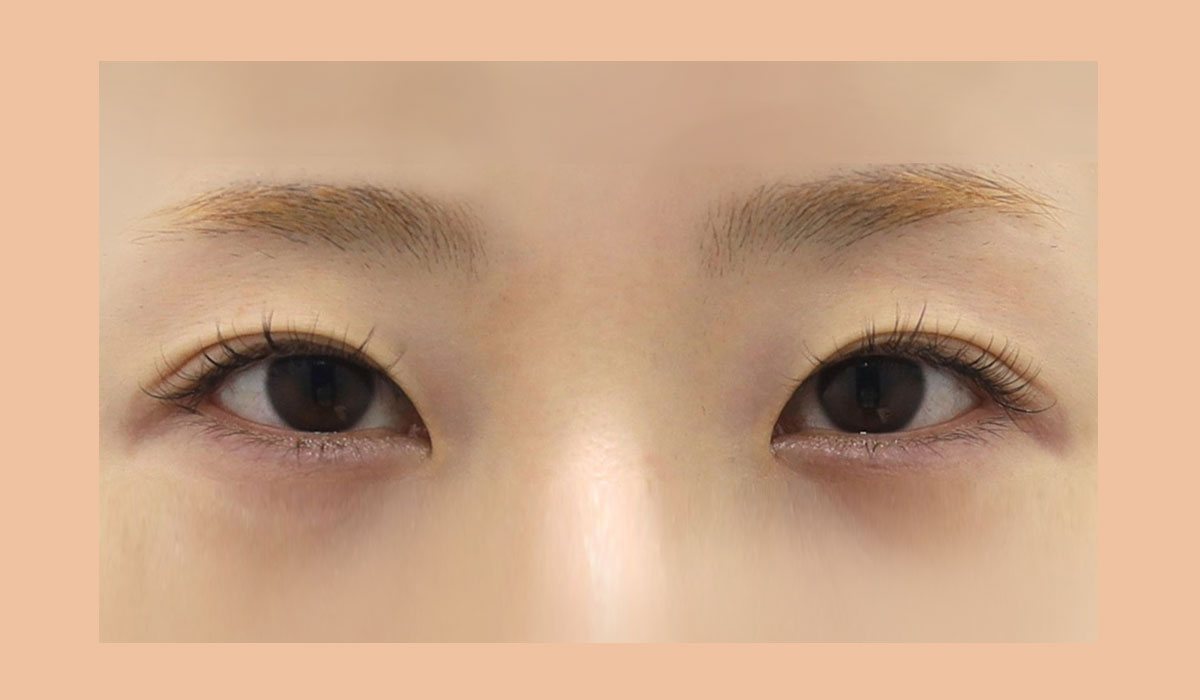 절개 뒤밑트임 전후 사례 수술 전