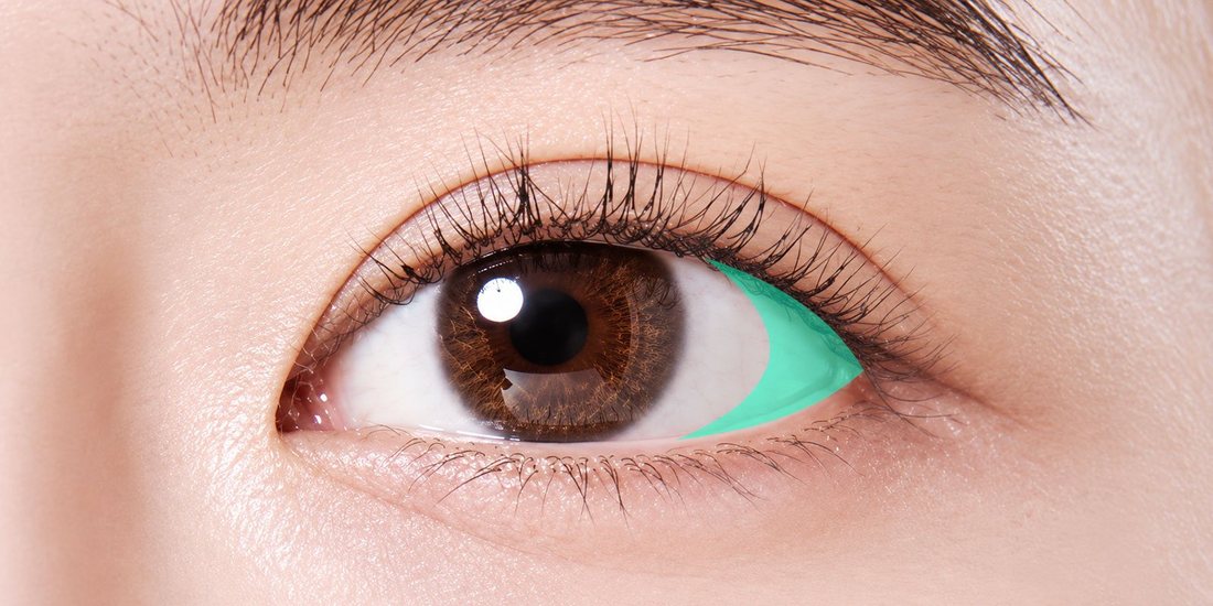 절개 뒤트임 수술 원리 — 눈 바깥쪽(뒤트임 방향) 민트색 표시