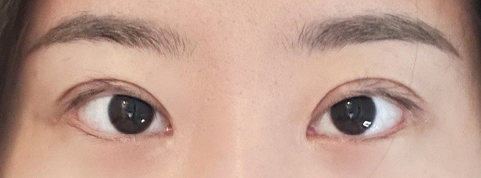 눈 수술 전 후 후기 쌍수 재수술 전 후 사진