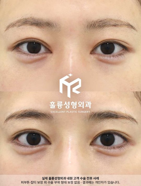 인스타그램 — 실제 훌륭성형외과 내원 고객 수술 전후 사례