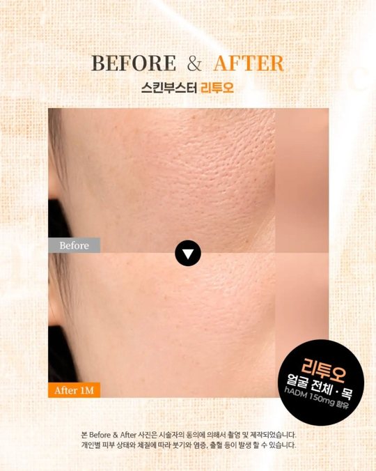 인스타그램 — BEFORE & AFTER — 스킨부스터 리투오