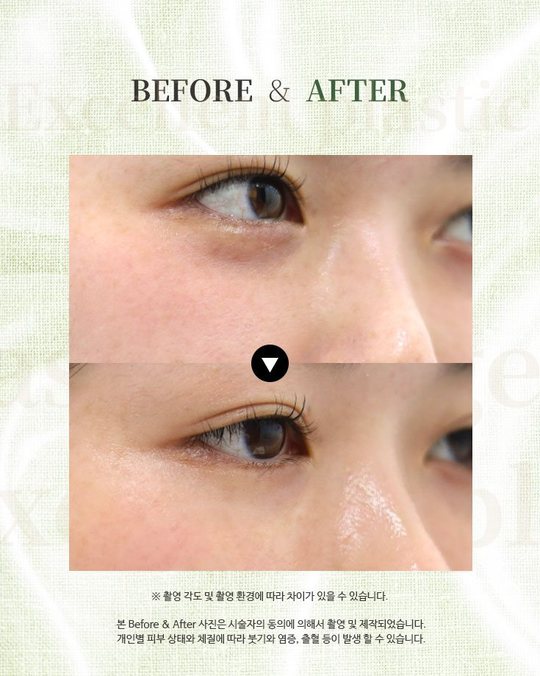 인스타그램 — BEFORE & AFTER