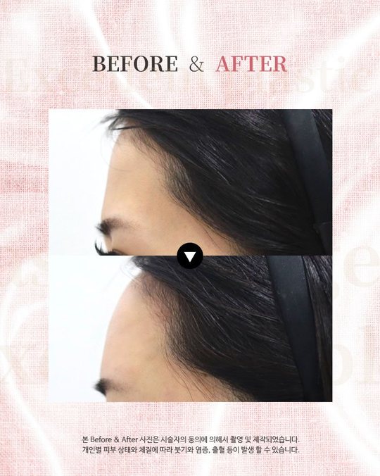 인스타그램 — BEFORE & AFTER