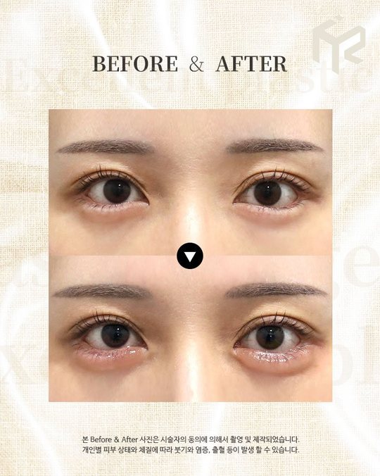 인스타그램 — BEFORE & AFTER