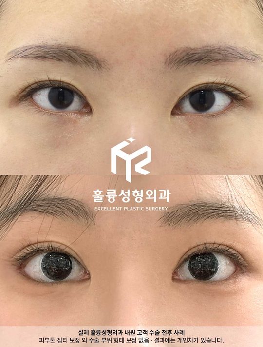 인스타그램 — 실제 훌륭성형외과 내원 고객 수술 전후 사례