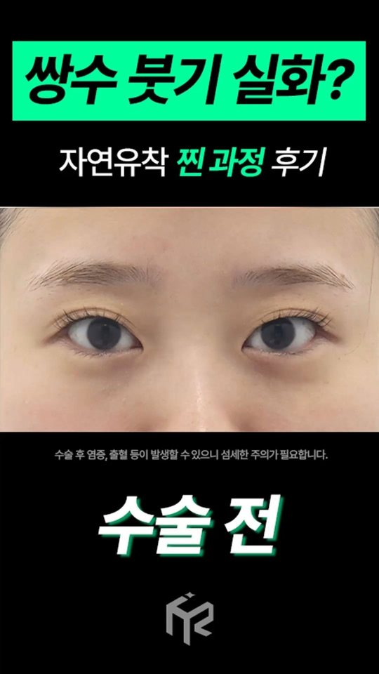인스타그램 — 쌍수 붓기 실화? 자연유착 찐 과정 후기