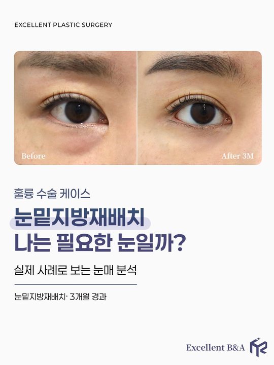 인스타그램 — 훌륭 수술 케이스 — 눈밑지방재배치 나는 필요한 눈일까?