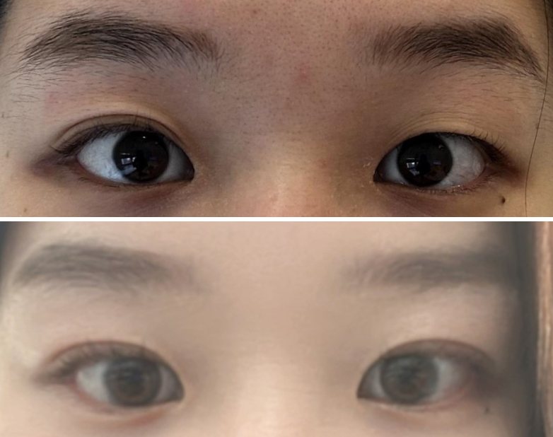 자연유작 후기 — 수술 전후 사진(위·아래 또는 좌우)