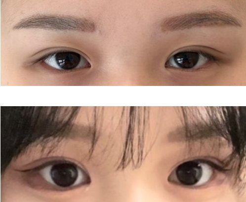 비절개 뒤밑트임 수술 후기 — 수술 전후 사진(위·아래 또는 좌우)