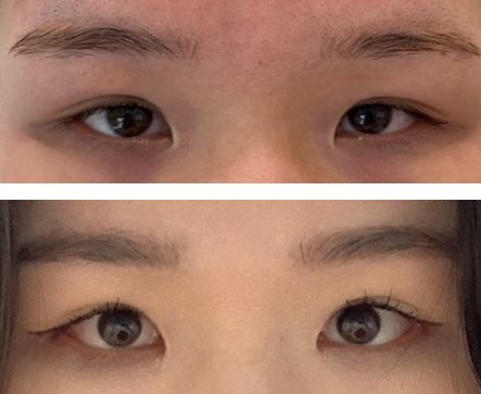 절개 뒤밑트임,앞트임 후기 — 수술 전후 사진(위·아래 또는 좌우)