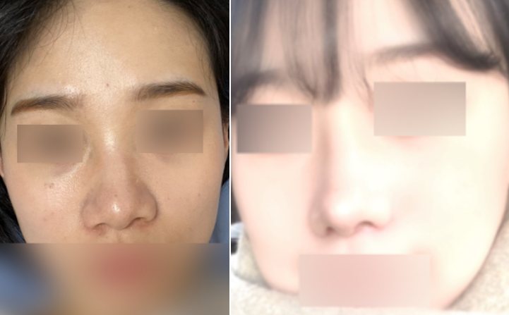 코 수술 후기(비중격) — 수술 전후 사진(위·아래 또는 좌우)