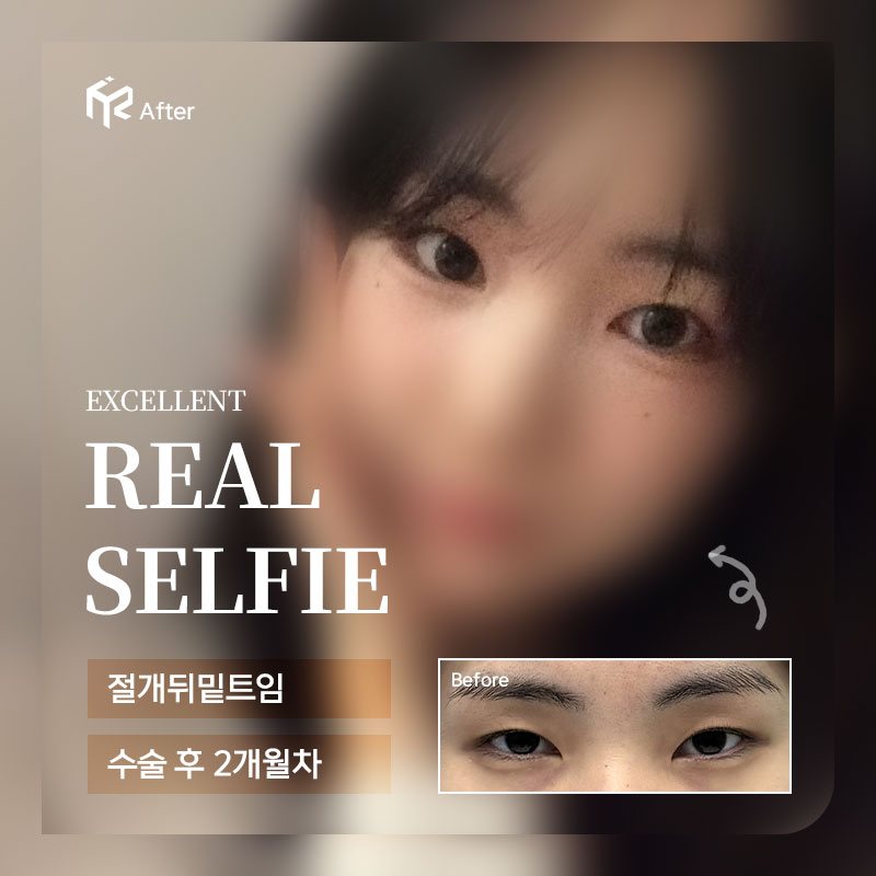REAL SELFIE — 절개뒤밑트임 수술 후 2개월차(After 큰 사진 + Before 작은 사진)