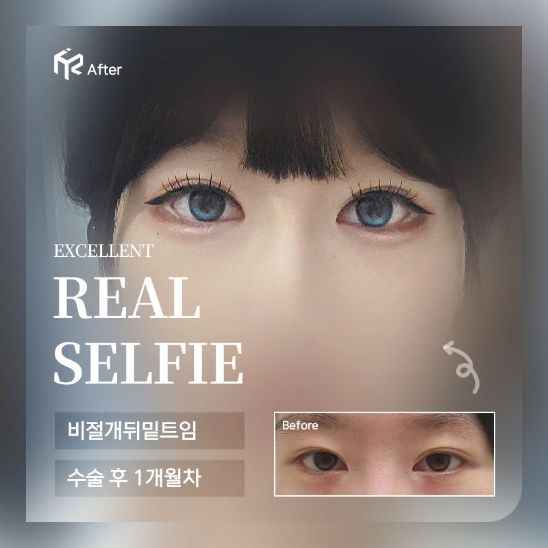 REAL SELFIE — 비절개뒤밑트임 수술 후 1개월차(After 큰 사진 + Before 작은 사진)