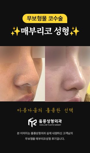 무보형물 코수술 아름다움의 훌륭한 선택 ✨매부리코 성형✨ 본 이미지는 훌륭성형외과 실제 내원하신 고객님의 무보형물 매부리코성형 후기입니다.