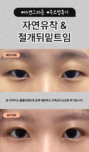 #자연스러운 #무보정후기 자연유착 & 절개뒤밑트임 본 이미지는 훌륭성형외과 실제 내원하신 고객님의 눈성형 후기입니다.