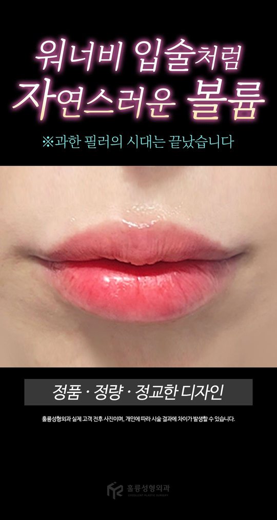 ※과한 필러의 시대는 끝났습니다 워너비 입술처럼 자연스러운 볼륨 정품 · 정량 · 정교한 디자인 훌륭성형외과 실제 고객 전후 사진이며, 개인에 따라 시술 결과에 차이가 발생할 수 있습니다.