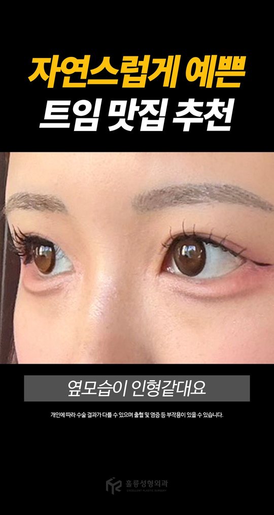 자연스럽게 예쁜 트임 맛집 추천 옆모습이 인형같대요 개인에 따라 수술 결과가 다를 수 있으며 출혈 및 염증 등 부작용이 있을 수 있습니다.