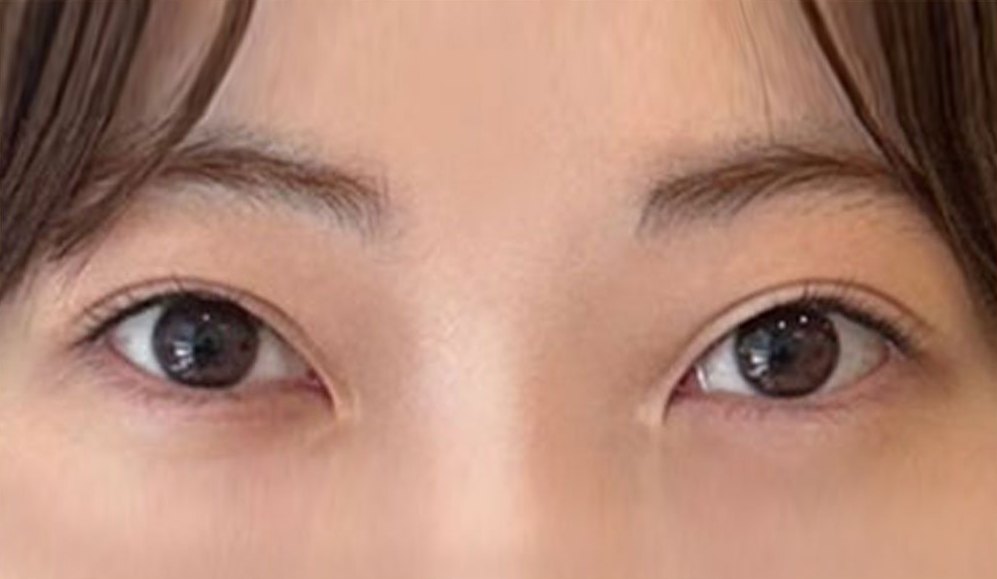 CASE 02 절개 뒤밑트임 수술 전