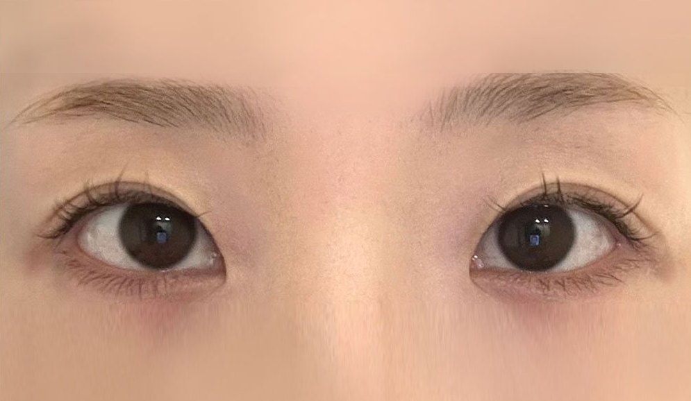 CASE 05 절개 뒤밑트임 수술 후