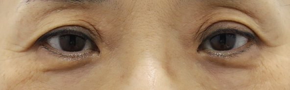 훌륭 리얼후기 — 코 성형 수술 전 후 후기 수술 전 후 사진(목록 썸네일, 눈 사진)