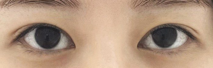 훌륭 리얼후기 — 트임 수술 전 후 후기 수술 전 후 사진(목록 썸네일, 눈 사진)