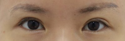 훌륭 리얼후기 — 트임 수술 전 후 후기 수술 전 후 사진(목록 썸네일, 눈 사진)