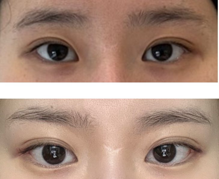 절개 뒤밑트임 수술 후기 — 수술 전후 사진(위·아래 또는 좌우)