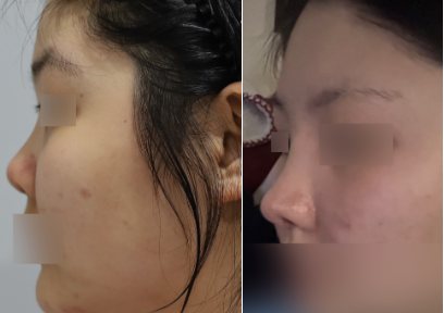 코 수술 (기증늑연골) 후기 — 수술 전후 사진(위·아래 또는 좌우)