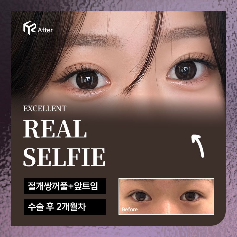 REAL SELFIE — 절개쌍꺼풀+앞트임 수술 후 2개월차(After 큰 사진 + Before 작은 사진)