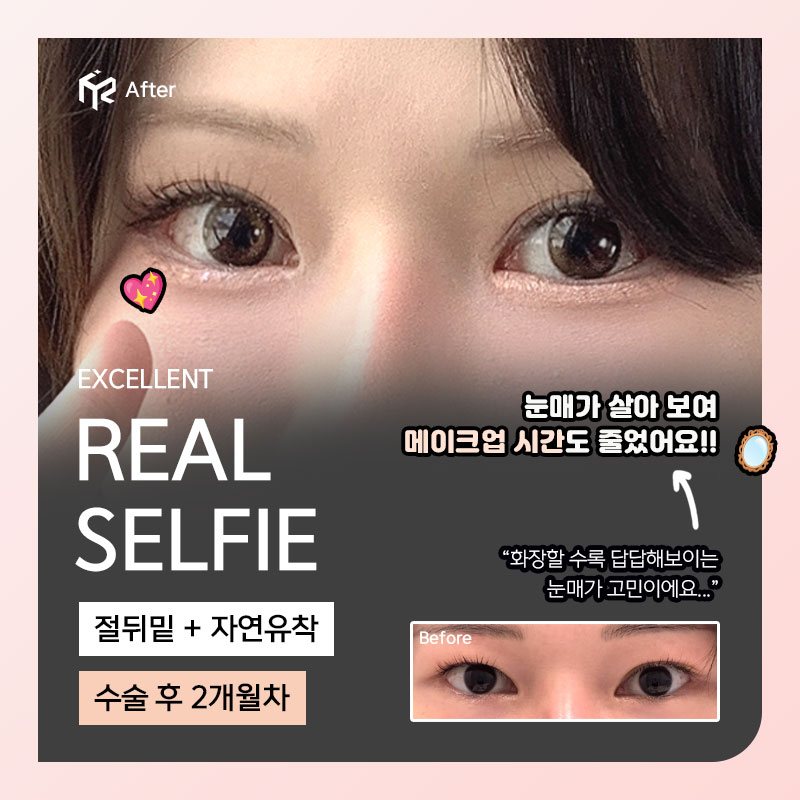 REAL SELFIE — 절뒤밑 + 자연유착 수술 후 2개월차(After 큰 사진 + Before 작은 사진)