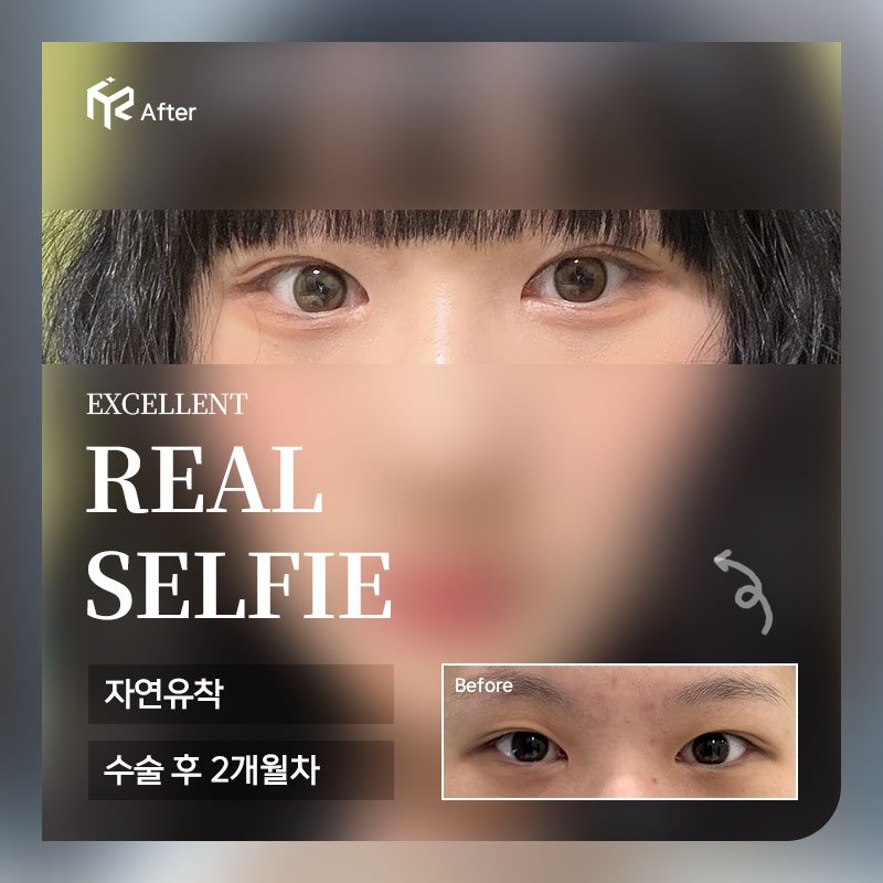 REAL SELFIE — 자연유착 수술 후 2개월차(After 큰 사진 + Before 작은 사진)
