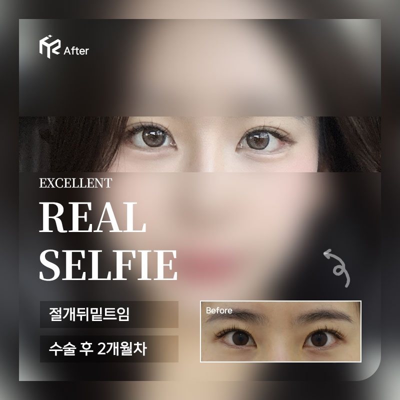 REAL SELFIE — 절개뒤밑트임 수술 후 2개월차(After 큰 사진 + Before 작은 사진)