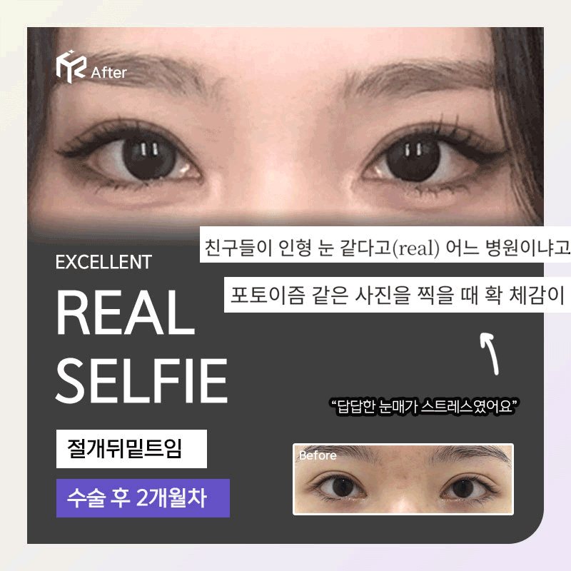 REAL SELFIE — 절개뒤밑트임 수술 후 2개월차(After 큰 사진 + Before 작은 사진)