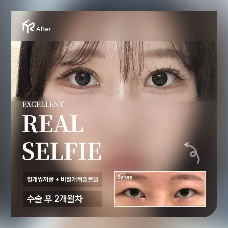 REAL SELFIE — 절개쌍꺼풀 + 비절개뒤밑트임 수술 후 2개월차(After 큰 사진 + Before 작은 사진)