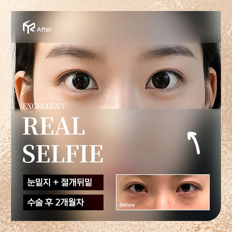 REAL SELFIE — 눈밑지 + 절개뒤밑 수술 후 2개월차(After 큰 사진 + Before 작은 사진)