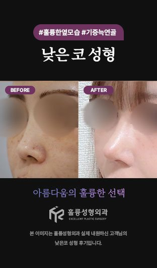 #훌륭한옆모습 #기증늑연골 / 낮은 코 성형 / 아름다움의 훌륭한 선택 / 본 이미지는 훌륭성형외과 실제 내원하신 고객님의 낮은코 성형 후기입니다.