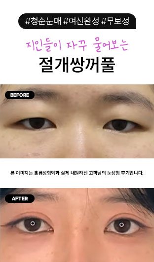 #청순눈매 #여신완성 #무보정 / 절개쌍꺼풀 / 지인들이 자꾸 물어보는 / 본 이미지는 훌륭성형외과 실제 내원하신 고객님의 눈성형 후기입니다.
