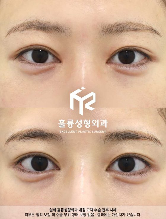 실제 훌륭성형외과 내원 고객 수술 전후 사례 / 피부톤·잡티 보정 외 수술 부위 형태 보정 없음 · 결과에는 개인차가 있습니다.