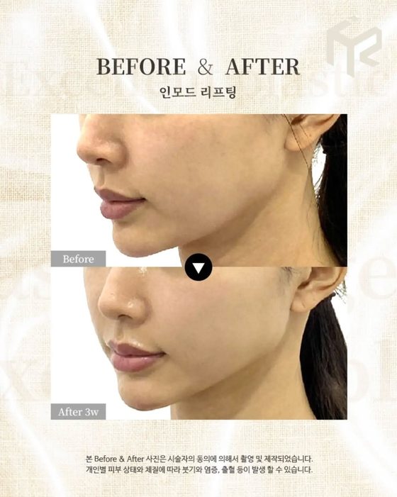 BEFORE & AFTER — 인모드 리프팅 / Before · After 3w / 본 Before & After 사진은 시술자의 동의에 의해서 촬영 및 제작되었습니다. 개인별 피부 상태와 체질에 따라 붓기와 염증, 출혈 등이 발생 할 수 있습니다.
