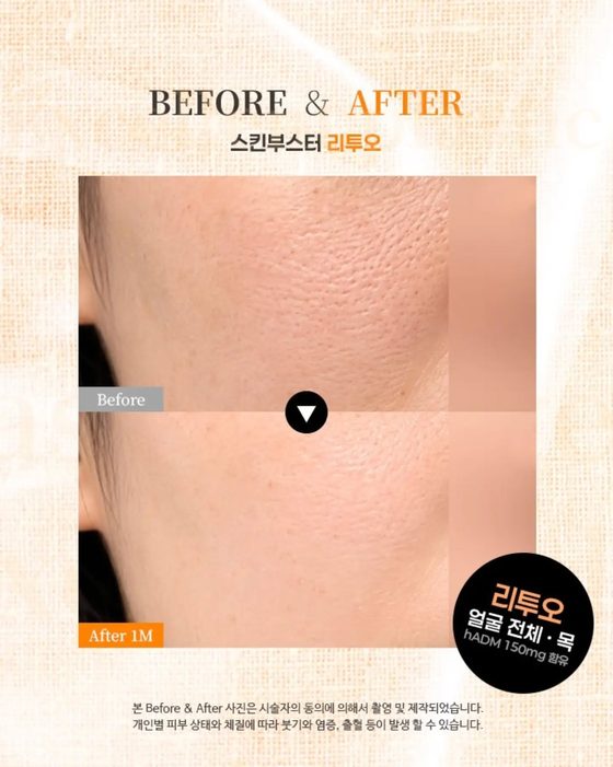 BEFORE & AFTER — 스킨부스터 리투오 / Before · After 1M / 리투오 얼굴 전체 · 목 / hADM 150mg 함유 / 본 Before & After 사진은 시술자의 동의에 의해서 촬영 및 제작되었습니다. 개인별 피부 상태와 체질에 따라 붓기와 염증, 출혈 등이 발생 할 수 있습니다.