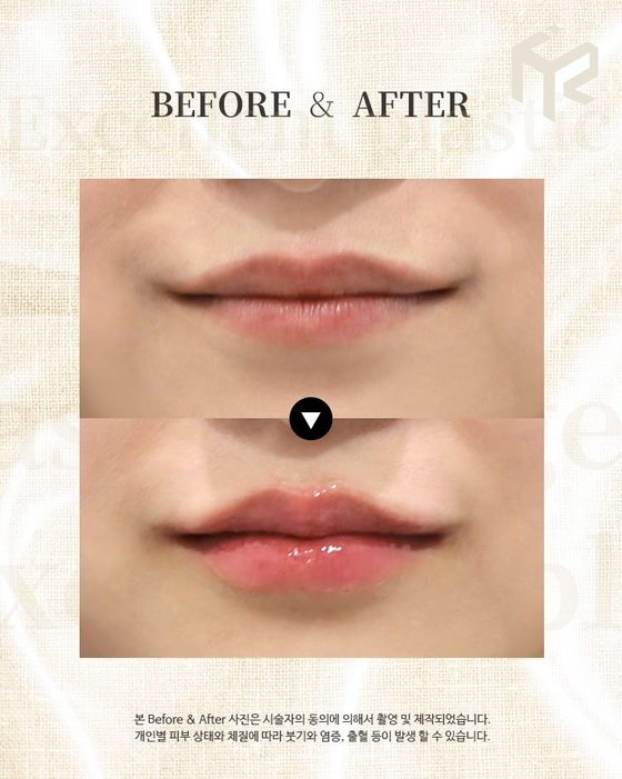 BEFORE & AFTER / 본 Before & After 사진은 시술자의 동의에 의해서 촬영 및 제작되었습니다. 개인별 피부 상태와 체질에 따라 붓기와 염증, 출혈 등이 발생 할 수 있습니다.