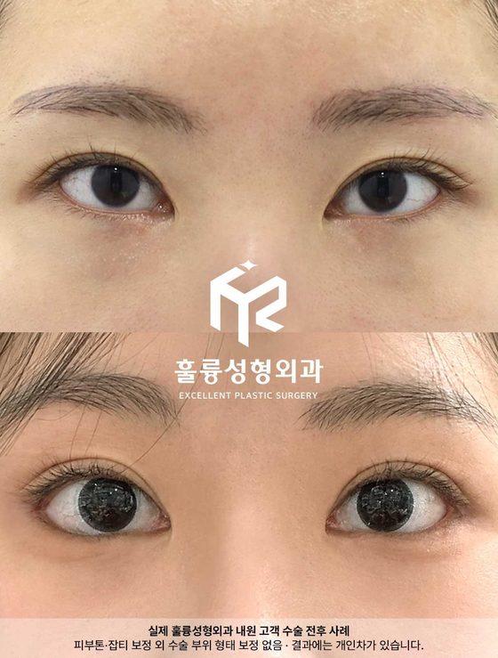 실제 훌륭성형외과 내원 고객 수술 전후 사례 / 피부톤·잡티 보정 외 수술 부위 형태 보정 없음 · 결과에는 개인차가 있습니다.