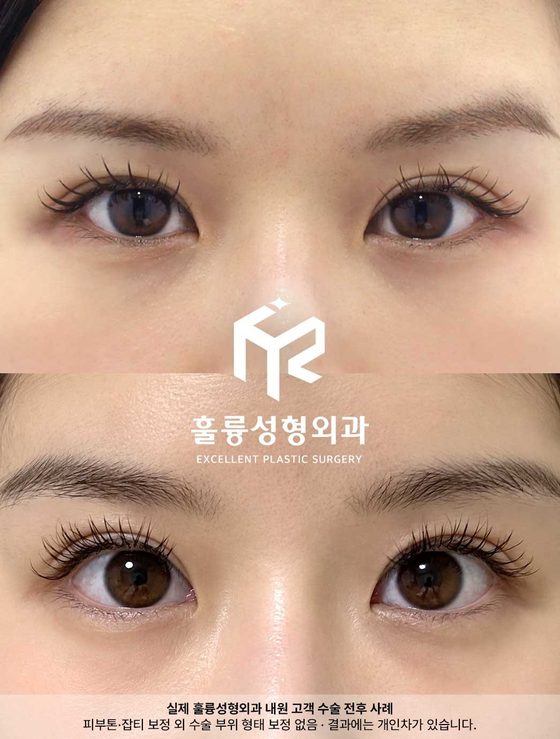 실제 훌륭성형외과 내원 고객 수술 전후 사례 / 피부톤·잡티 보정 외 수술 부위 형태 보정 없음 · 결과에는 개인차가 있습니다.