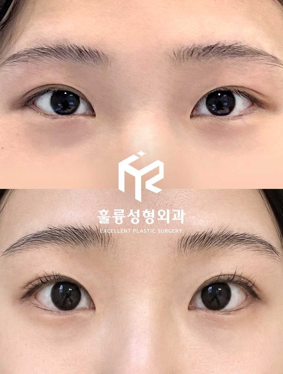 수술 전후 눈 사진(가운데 훌륭성형외과 로고) — 그림 속 글 없음